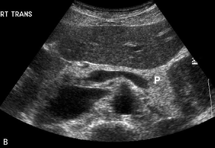 Diagnóstico diferencial da pancreatite