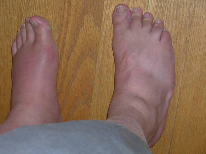 diet for gout during an exacerbation