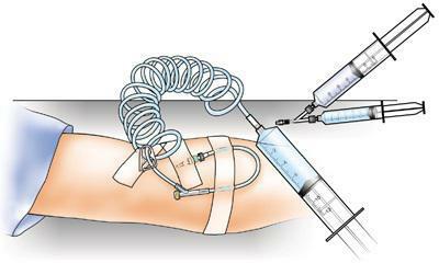 algoritm pentru injectarea intravenoasă