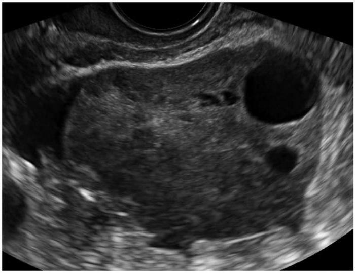 spôsobiť ovariálne fibroidy