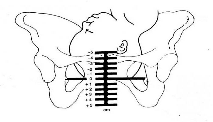 Clinically narrow pelvis