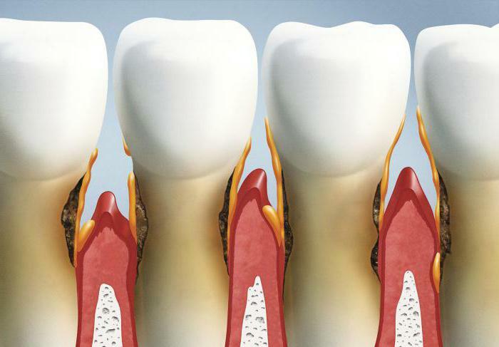 features of periodontal diseases