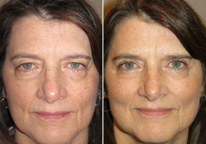 blepharoplasty in Moscow the best surgeons