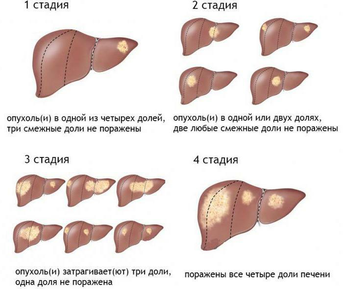 v poslednej fáze rakoviny pečene