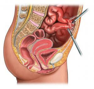 ovarian laparoscopie