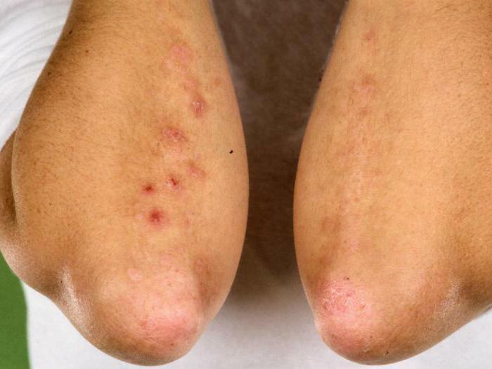 herpetiform dermatitis treatment