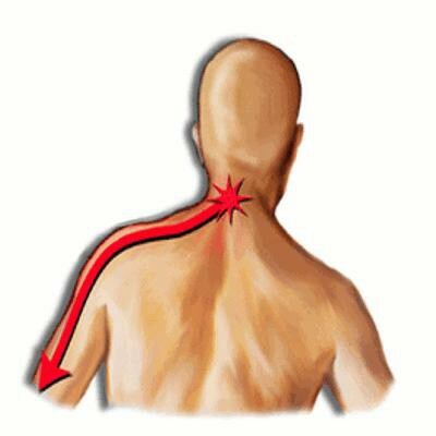 brahialgia cervicală vertebrogenă