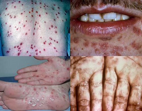consequences of syphilis treatment