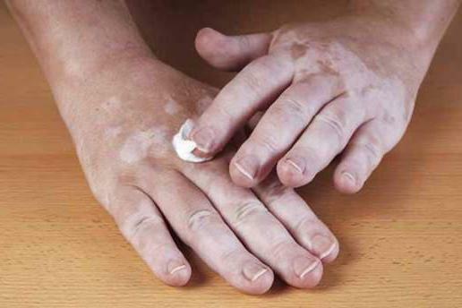 vitex gel from vitiligo