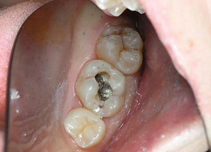 علاج مراحل التهاب لب السن