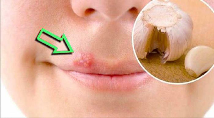 Herpes on the lips treatment of folk remedies quickly
