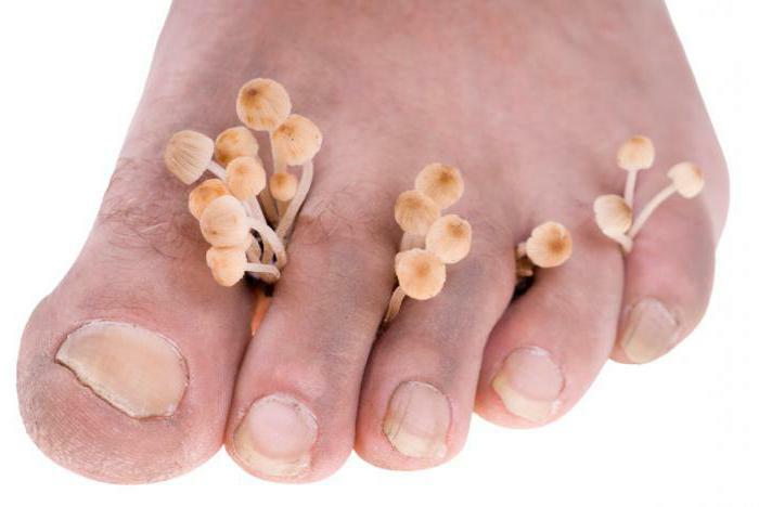 fungal foot disease treatment