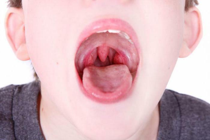 inflammation of the tonsils in adults