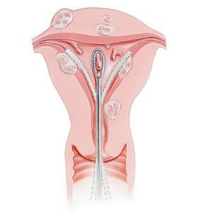 endometrial biopsy