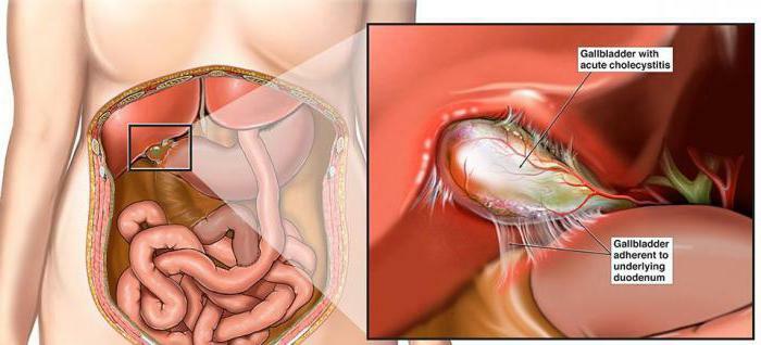 akútna akútna cholecystitída