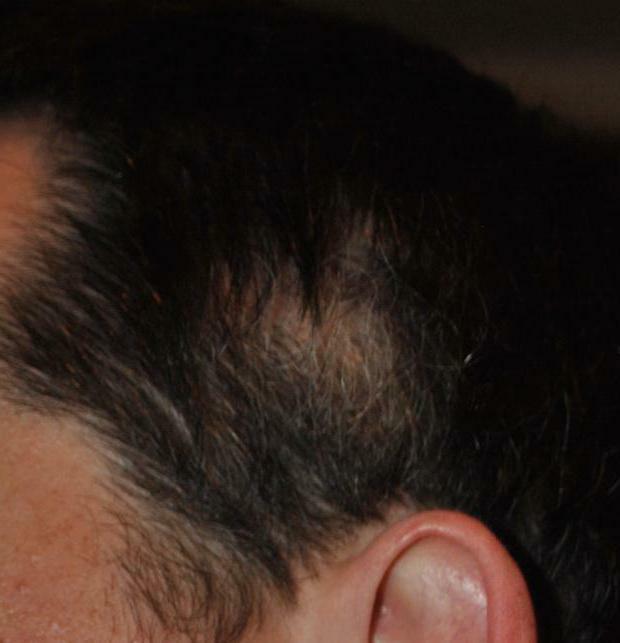 focal alopecia in men