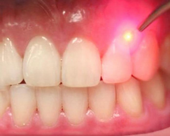 Causes on the gums of the cause