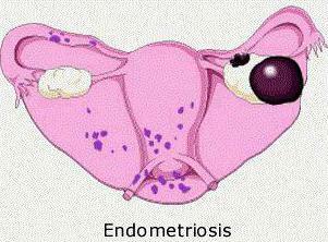 cyst of the right ovary endometrioid