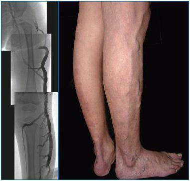 angiography of lower extremity vessels reviews