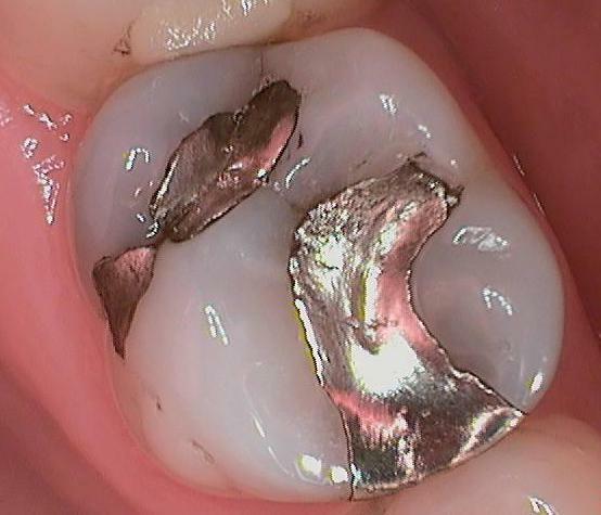 crack in the root of the tooth