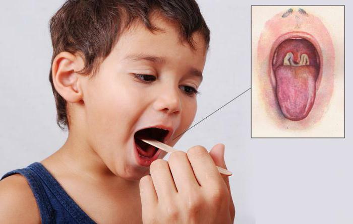 Diphtheria What Is It Causes Symptoms Prevention