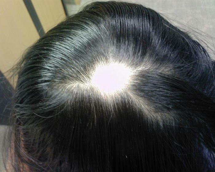 focal alopecie la femei