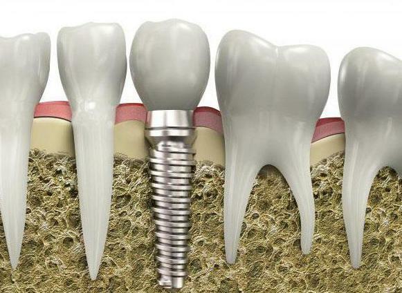 jednostupňová implantácia zubov