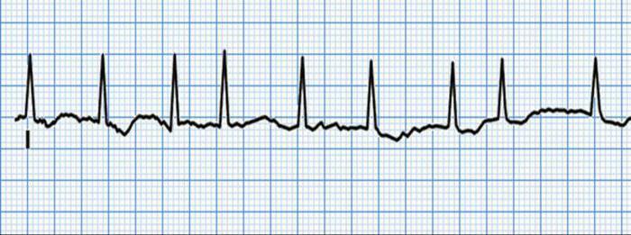 ekg fibrilácia