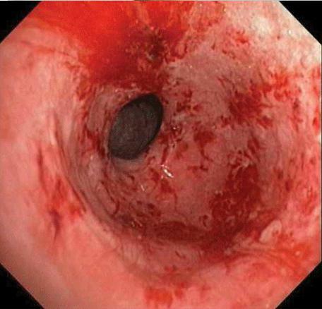decubital cervical ulcer