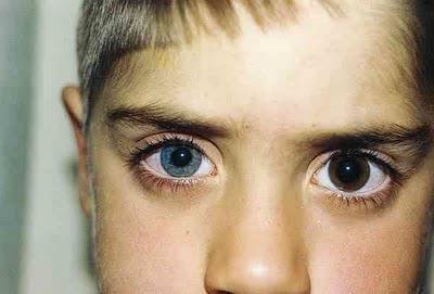 causes of anisocoria in adults