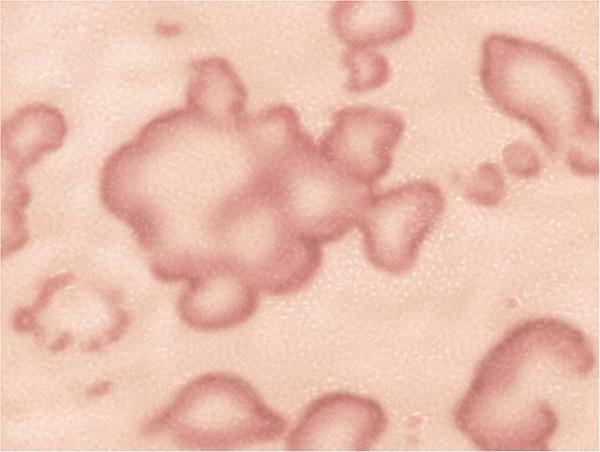 microbial eczema photo