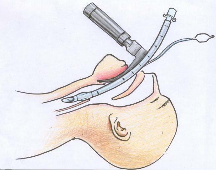 Tube in the throat during operation