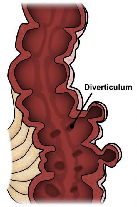 divertikulær sygdom