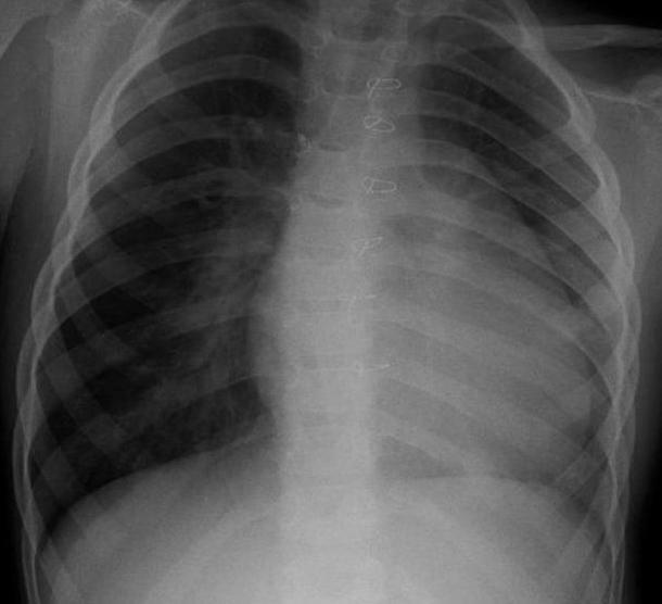 diagnóza tetralogie falusu