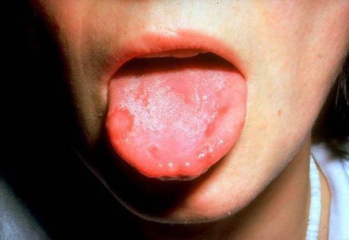 stomatitis in adults is contagious or not