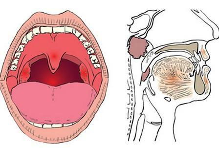 pharyngeal tonsil Photo