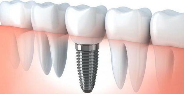 crown for implant