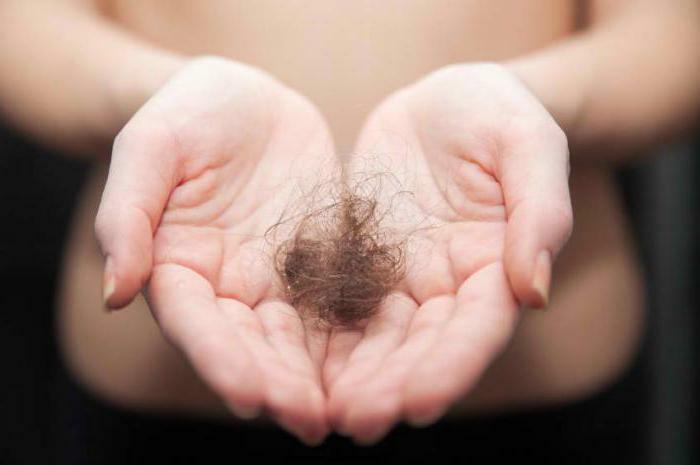 alopecie androgenetică la femei