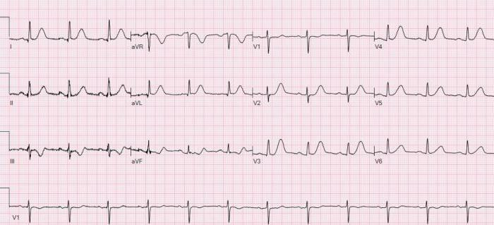 results ekg with load
