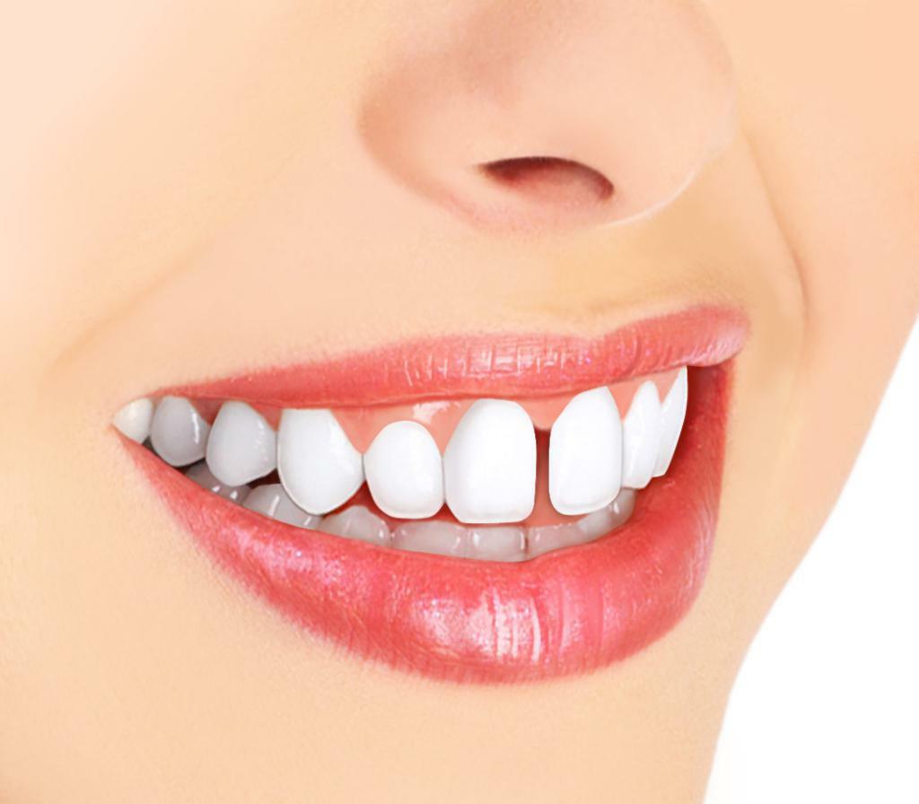 كيفية إزالة الفجوة بين الأسنان الأمامية؟