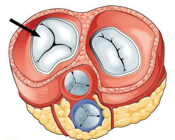 tricuspid valve failure