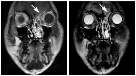 MRI of the sinuses of the nose: where to do what shows? Tomography of ...