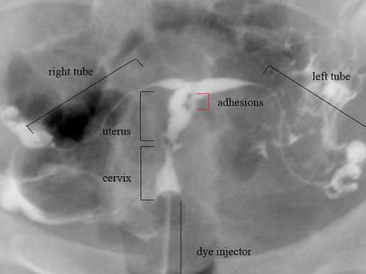 thickness of the scar on the uterus