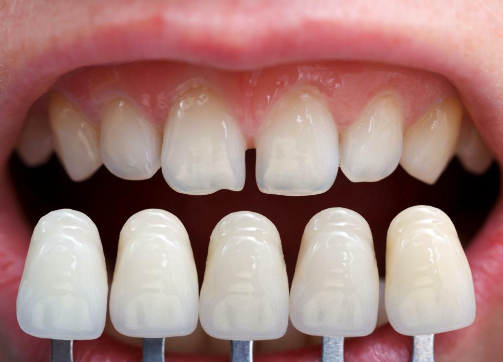 الفجوة بين الأسنان كيفية إصلاحه؟