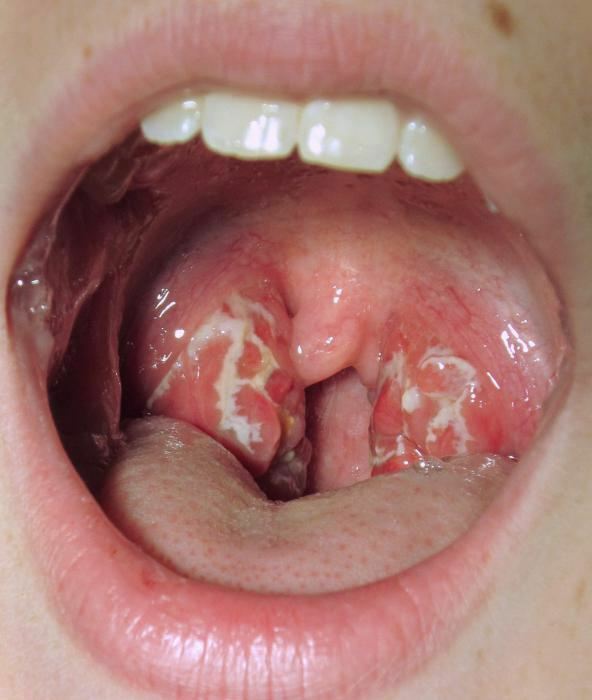 purulent inflammation of the tonsils