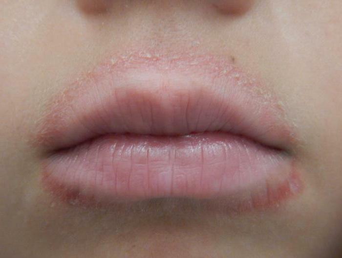 rashes around the mouth of an adult