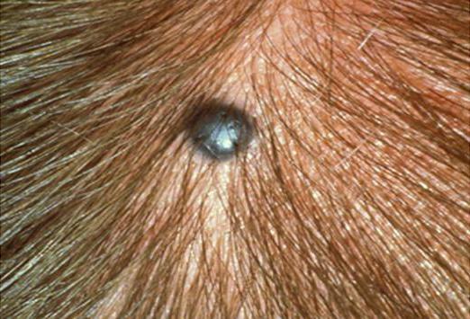 nevus birthmark