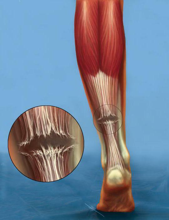 Treatment of ruptures of the Achilles tendon: surgery, rehabilitation