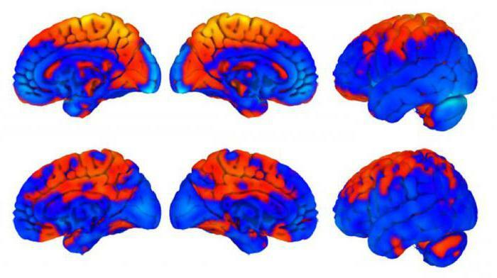 characteristic sign of cerebral compression