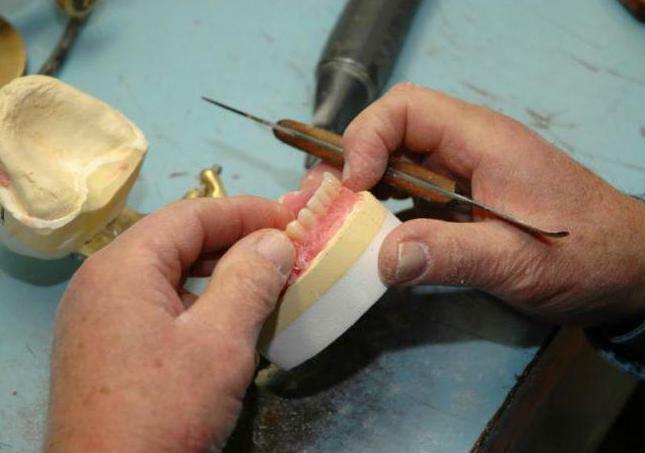 stages of manufacturing a clasp prosthesis on attachments
